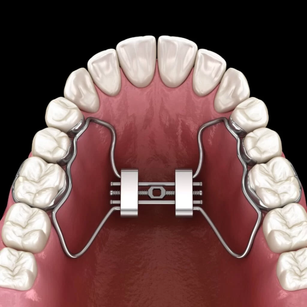 Entenda para que Serve o Aparelho Expansor